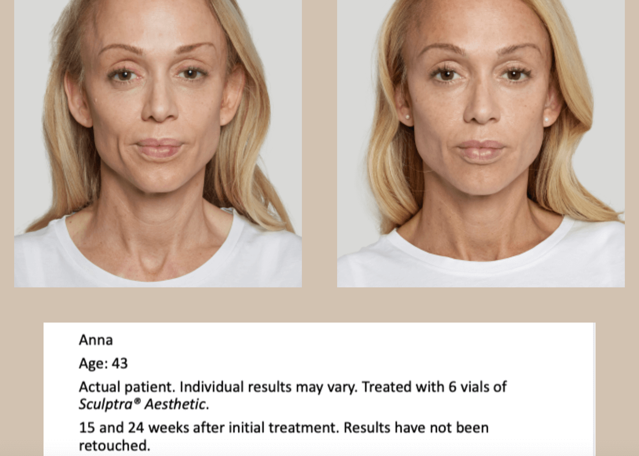 sculptra